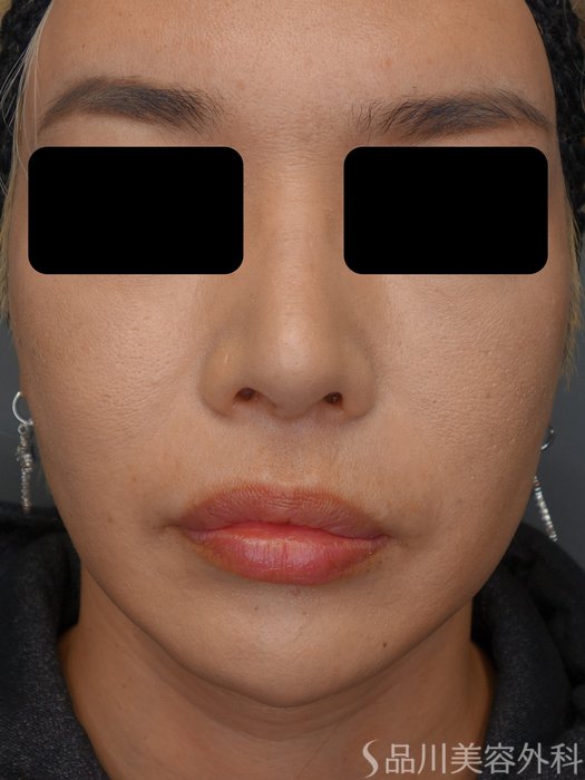 症例NO.73158のAFTER写真