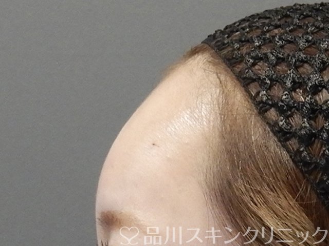 症例NO.64983のAFTER写真