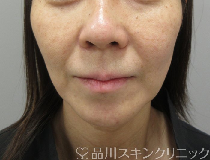 症例NO.73600のBEFORE写真