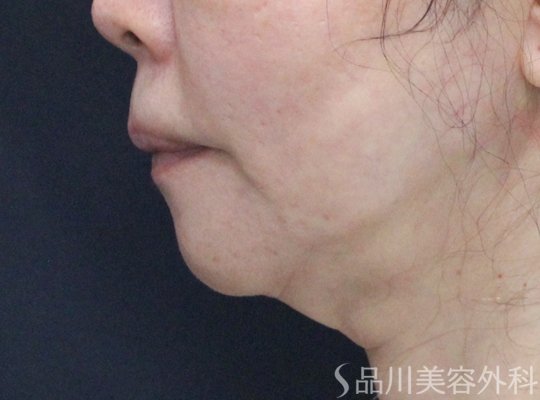 症例NO.75140のBEFORE写真