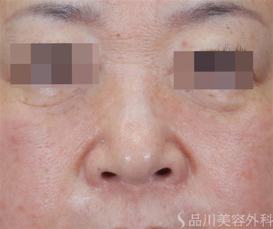 症例NO.60415のBEFORE写真