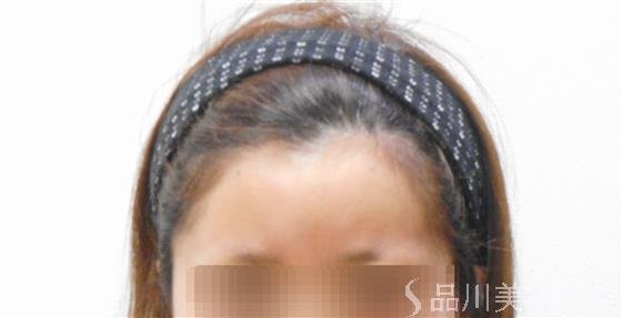 症例NO.42856のAFTER写真