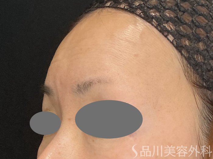 症例NO.72995のAFTER写真