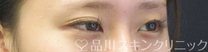 症例NO.68626のBEFORE写真