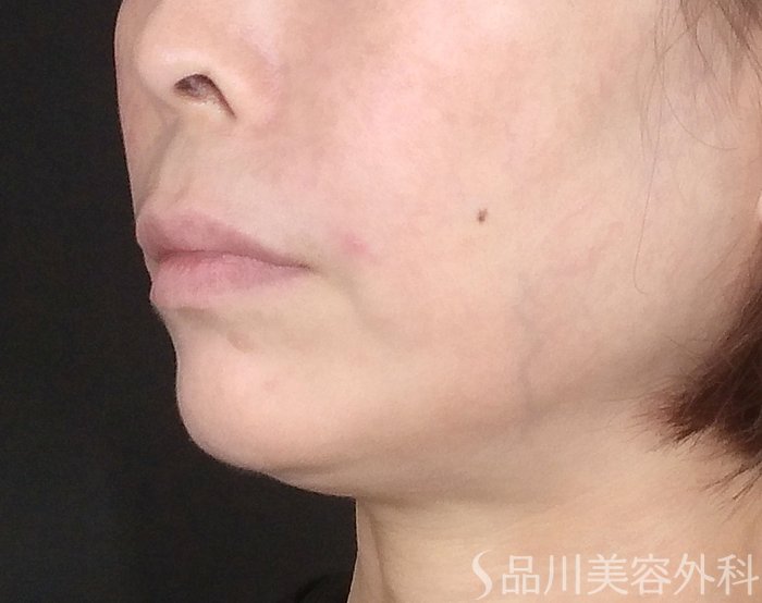症例NO.65308のAFTER写真