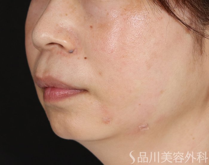 症例NO.71207のAFTER写真