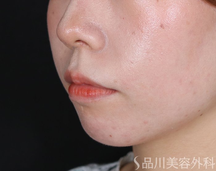 症例NO.71021のBEFORE写真