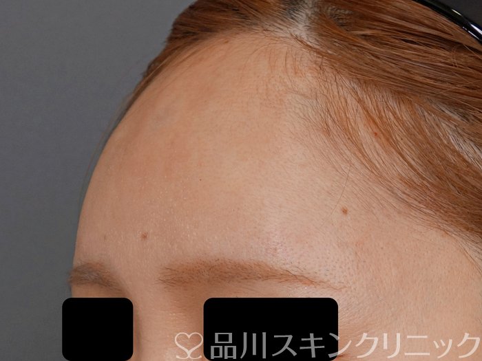 症例NO.71891のAFTER写真