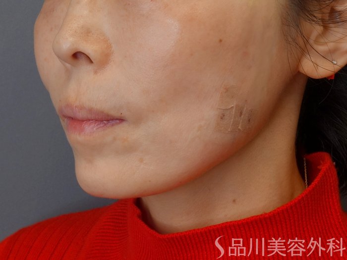 症例NO.73062のAFTER写真