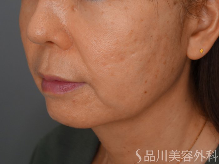 症例NO.74180のBEFORE写真