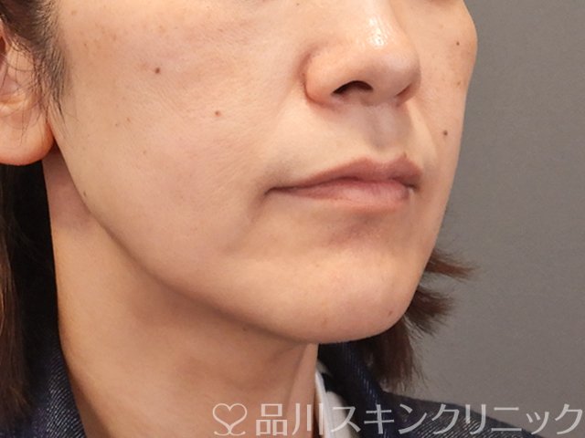 症例NO.75087のBEFORE写真