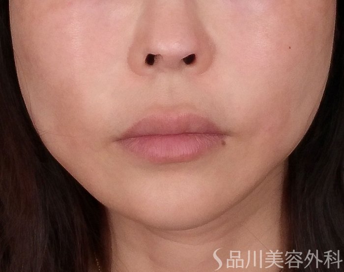 症例NO.69415のAFTER写真