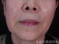 症例NO.73845のBEFORE写真