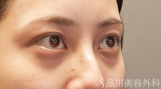 症例NO.74746のBEFORE写真