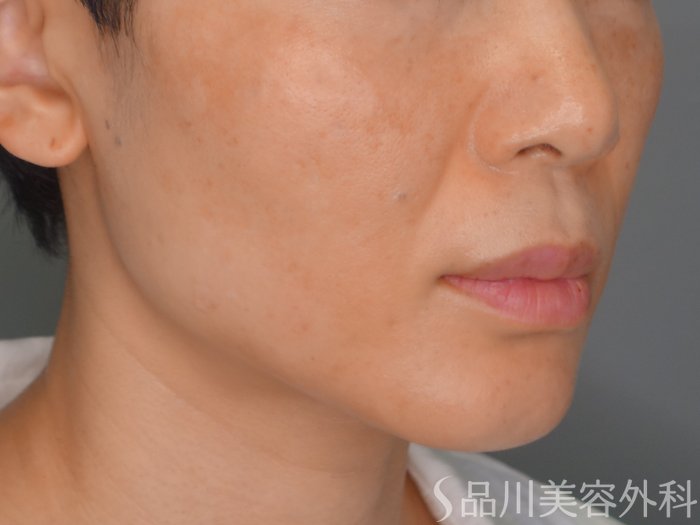 症例NO.69173のAFTER写真