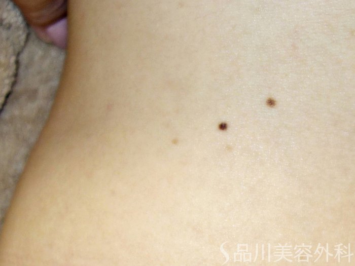 症例NO.73544のBEFORE写真