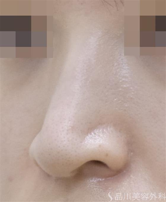 症例NO.50388のAFTER写真