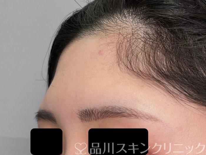 症例NO.70220のBEFORE写真