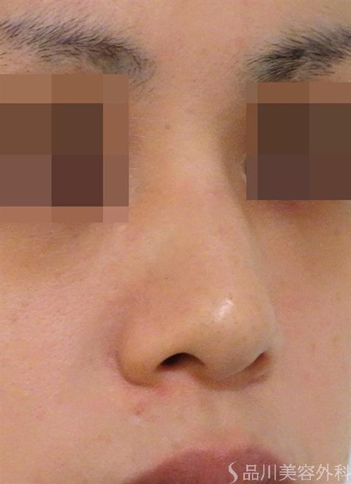 症例NO.39186のBEFORE写真