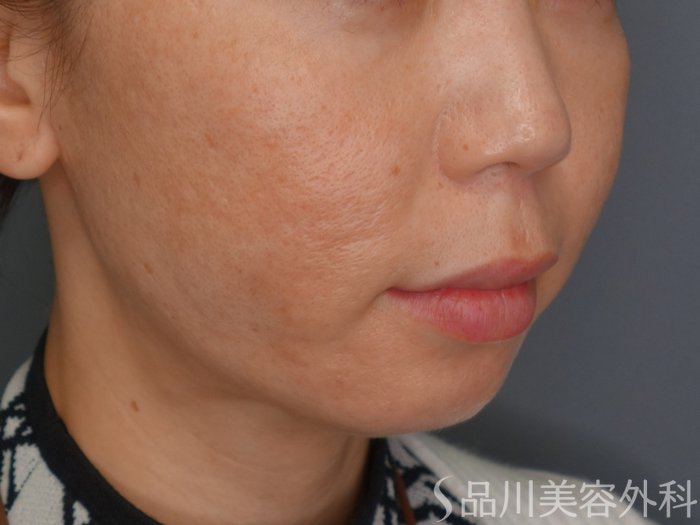 症例NO.73351のAFTER写真