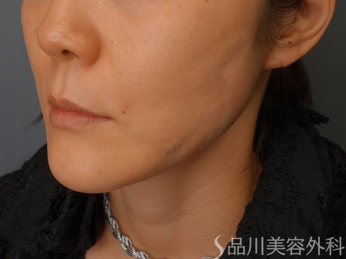 症例NO.62282のAFTER写真