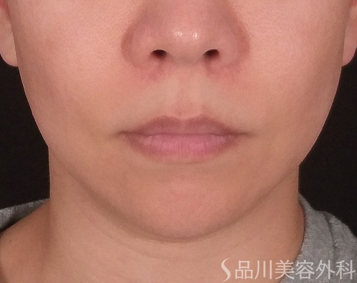 症例NO.73820のBEFORE写真