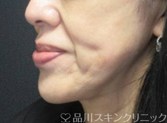 症例NO.72383のBEFORE写真