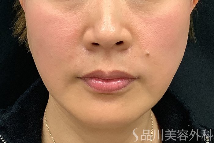 症例NO.73311のAFTER写真