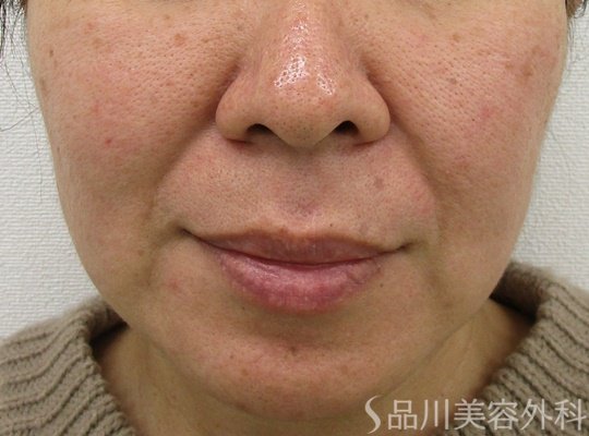 症例NO.62078のBEFORE写真