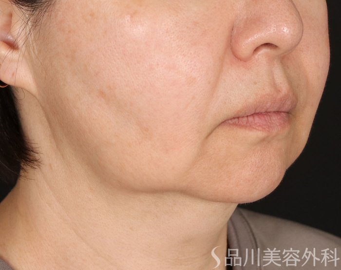 症例NO.73612のBEFORE写真