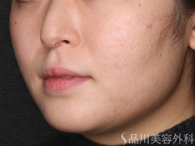 症例NO.75280のAFTER写真