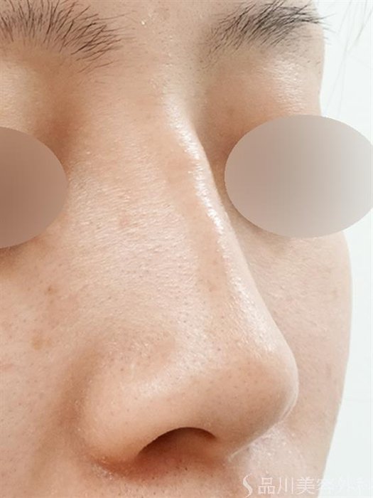 症例NO.43849のBEFORE写真