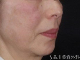 症例NO.73531のBEFORE写真