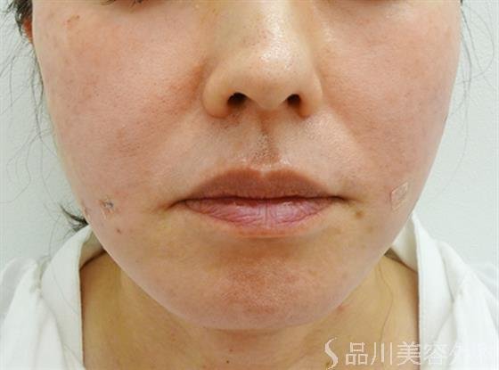 症例NO.49234のAFTER写真