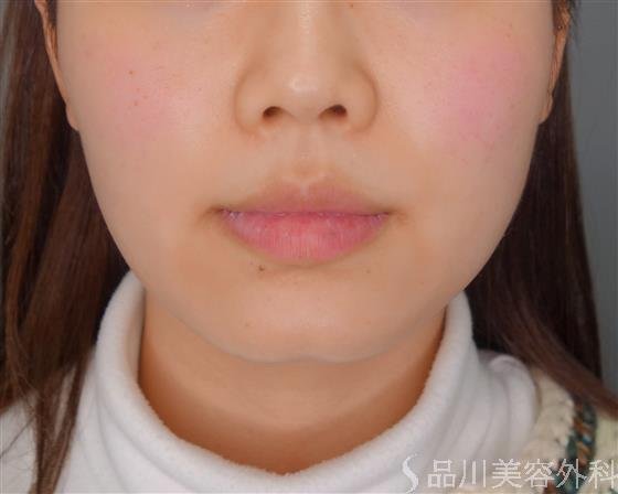 症例NO.54390のBEFORE写真