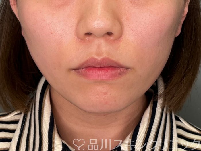 症例NO.69896のAFTER写真