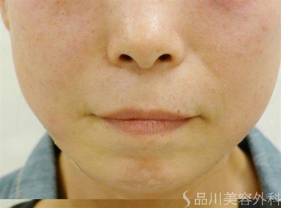 症例NO.34141のAFTER写真
