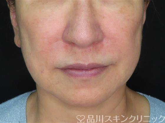 症例NO.57814のBEFORE写真