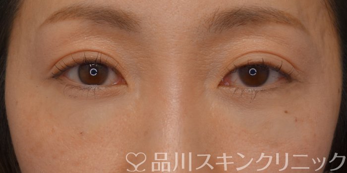 症例NO.74856のAFTER写真