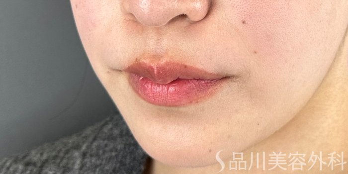 症例NO.69281のBEFORE写真