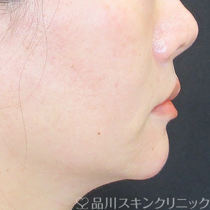症例NO.73941のAFTER写真