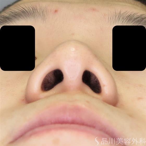 症例NO.49555のBEFORE写真