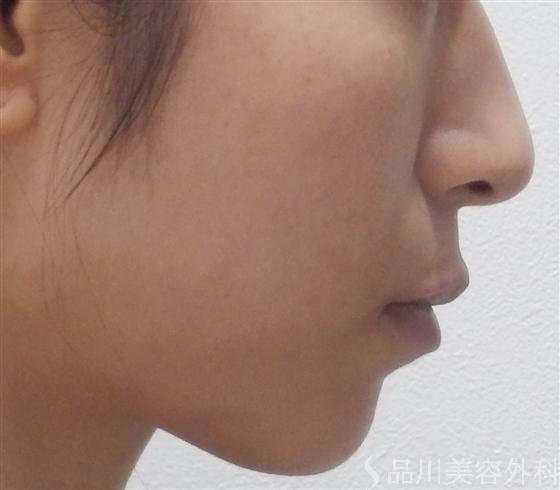 症例NO.14090のBEFORE写真