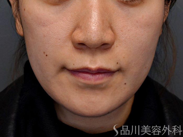症例NO.73840のBEFORE写真