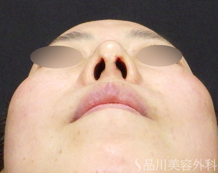 症例NO.72409のAFTER写真