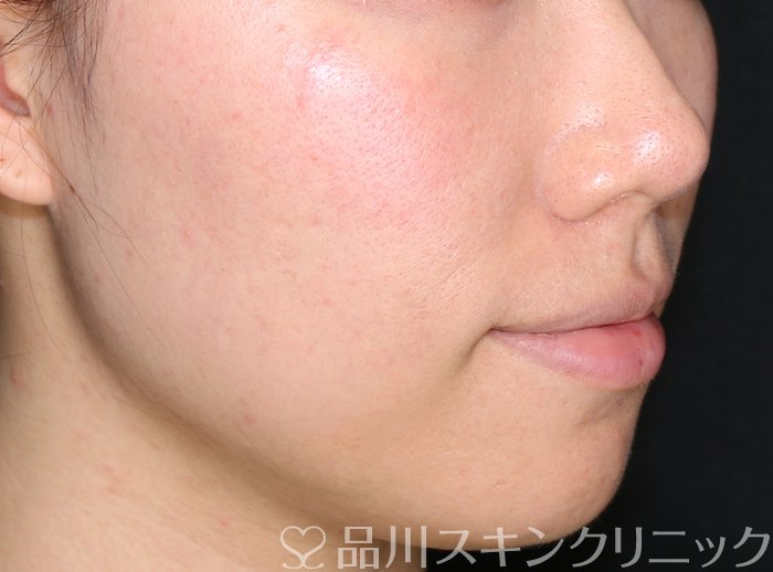 症例NO.69503のAFTER写真