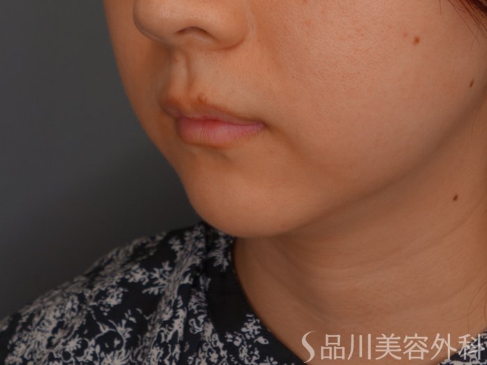 症例NO.64551のBEFORE写真