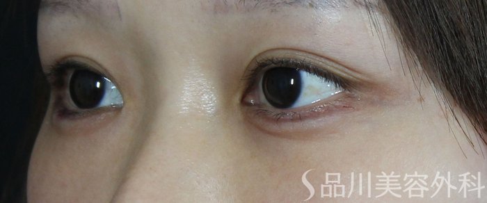 症例NO.72508のAFTER写真