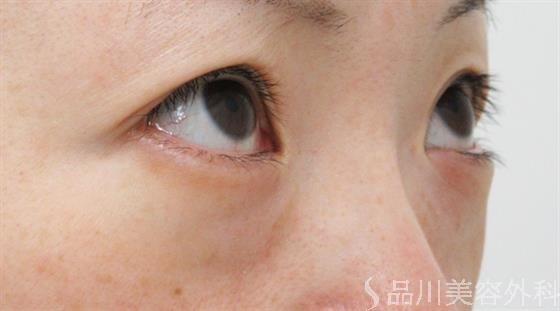 症例NO.22977のBEFORE写真