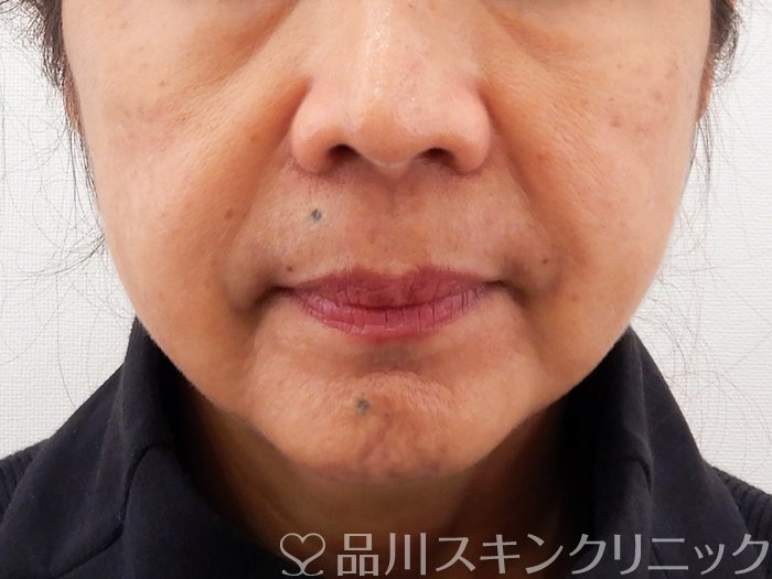 症例NO.62186のBEFORE写真